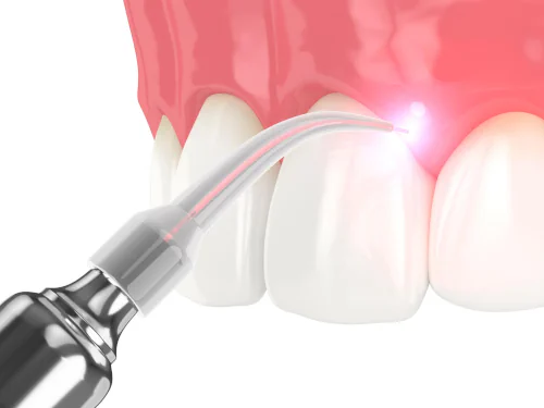 Soft Tissue Dental Laser in Burtonsville, MD