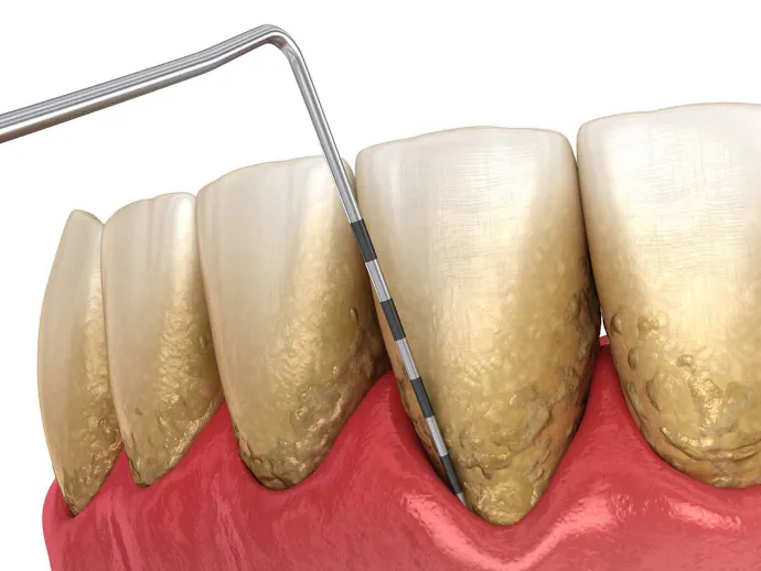 Gum Disease Treatment in Burtonsville, MD at Burtonsville Dental Suite